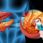 Cáncer de Páncreas, Un nuevo horizonte de esperanza se abre en el tratamiento de uno de los cánceres más letales.