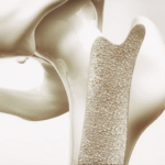 Hasta ahora, las terapias disponibles para la osteoporosis solo logran ralentizar el avance de la enfermedad y muchas de ellas presentan efectos secundarios relevantes o pierden eficacia con el tiempo.