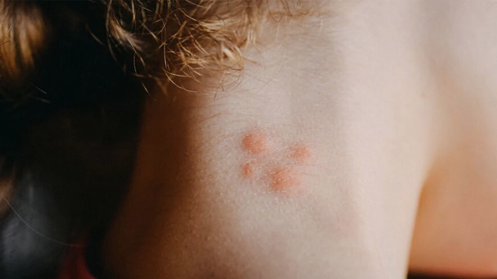 La enfermedad de Chagas llegó a Estados Unidos: los CDC reportan casos en ocho estados