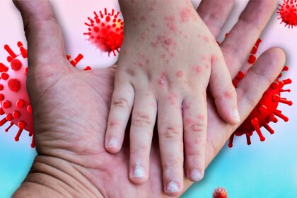 Brote de Sarampión en Florida: Identificando los síntomas en niños.