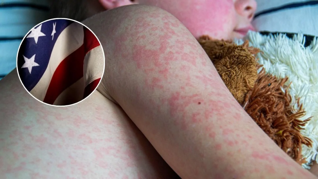 El Sarampión Regresa con Fuerza: Guía Completa de Síntomas, Peligros y Protección