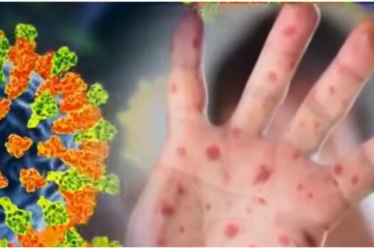 El Sarampión Regresa con Fuerza: Guía Completa de Síntomas, Peligros y Protección