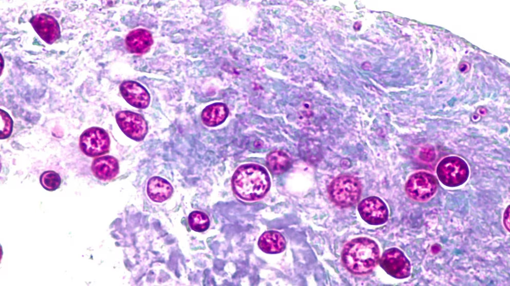 Brotes de Ciclosporiasis: Guía crítica para sobrevivir al verano